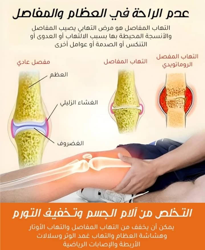 مرهم سم النحل لعلاج المفاصل