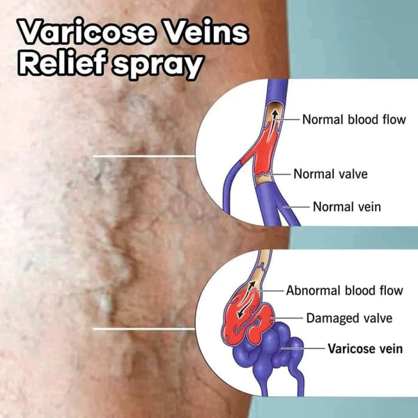 Spray Massage Varices بخاخ تدليك الدوالي